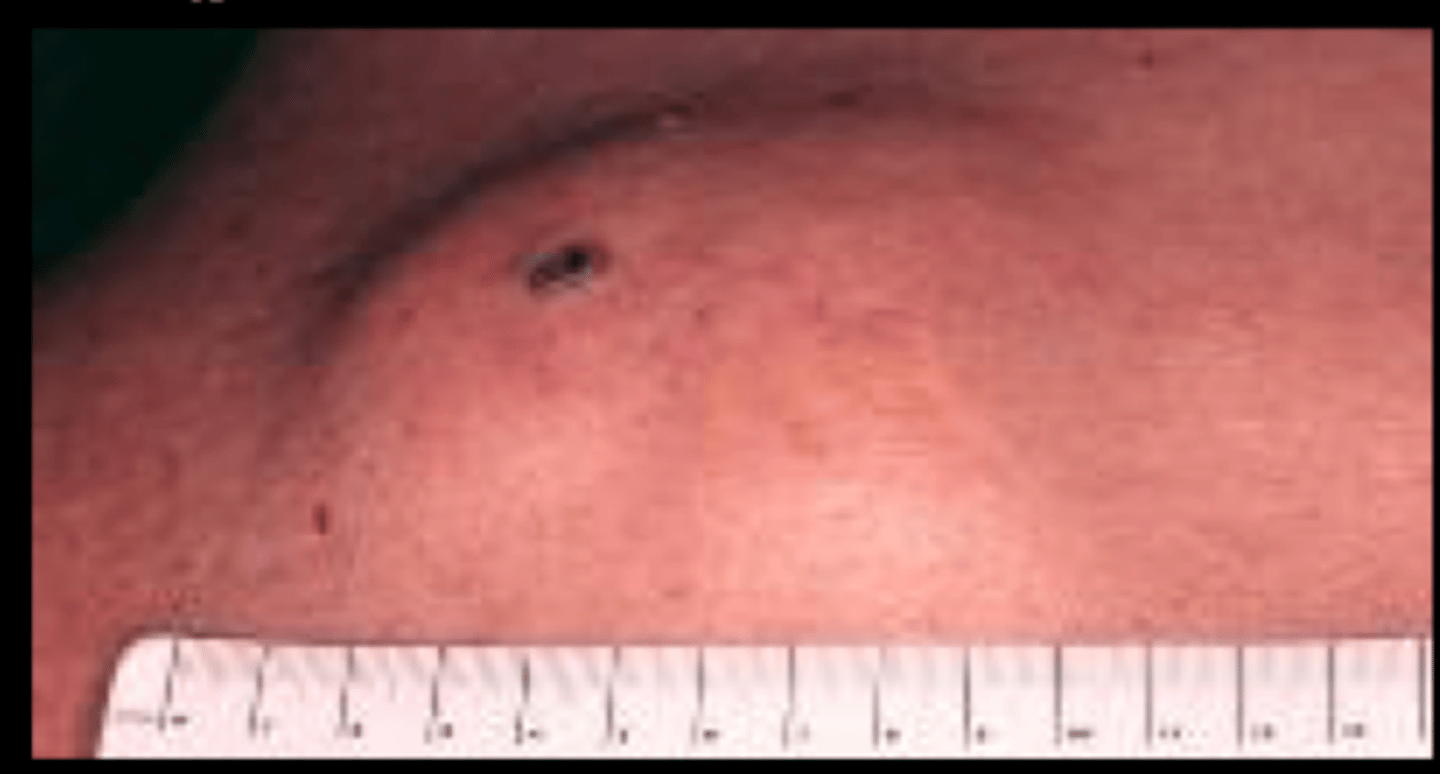 <p>Cysts</p>