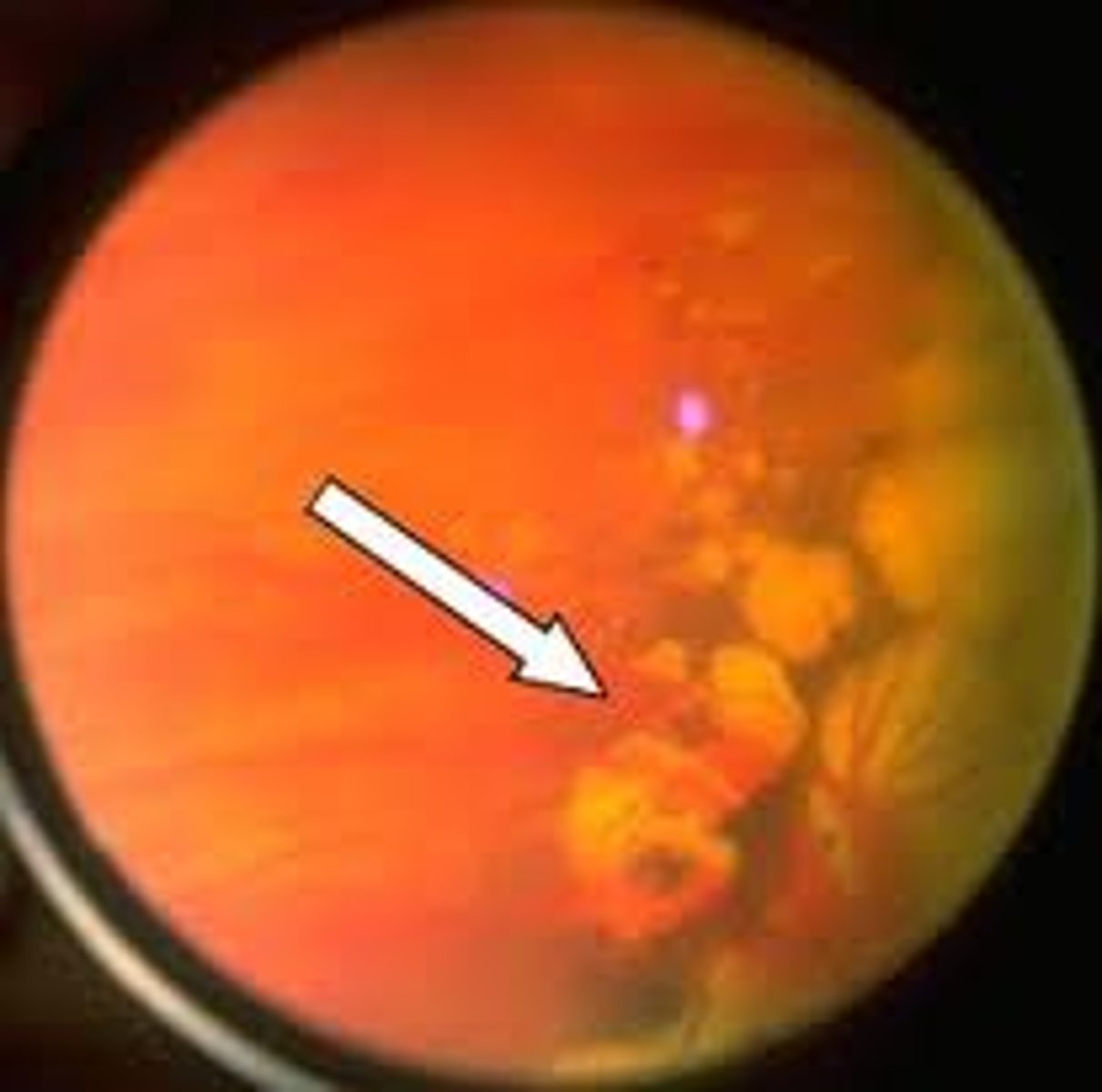 <p>Occurs in about 30% of all patients</p><p>• Peripheral retinal degeneration</p><p>• Small, pale, non-elevated, depigmented areas</p><p>• Usually bilateral, mostly seen inferiorly</p><p>• Choroidal vessels seen due to RPE and outer retina loss</p><p>• May increase with age</p><p>• Benign</p><p>• Differentiate from chorioretinal scars, retinal holes, lattice degeneration</p>