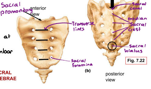 <p>Starts off as 5 separate vertebrae but fuse at adolescence into the sacrum. it articulates with the 5th lumbar and laterally with hip bones via sacroiliac joint.</p><p><strong>Sacral promontory:</strong> Basically the high point of sacral vertebrae</p><p><strong>Transverse lines: </strong>They mark the lines of fusion of the sacral vertebrae</p><p><strong>Sacral foramina:</strong> They transmit blood vessels and anterior rami of sacral spinal nerves.</p><p><strong>Median sacral crest:</strong> The fused spinous processes of sacral vertebrae</p><p>Sacral canal: The area where the vertebral canal continues inside the sacrum</p><p>Sacral hiatus: An enlarged external opening.</p>