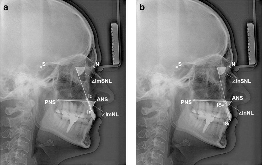 <ul><li><p>Radiopaque </p></li><li><p>Ex. Anterior Nasal spine </p></li><li><p>Radiographic Landmark used in Lateral Head Films for Ortho </p></li></ul><p></p>