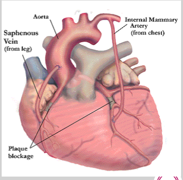 <ul><li><p>coronary artery bypass grafting</p></li><li><p>grafts used as detour around blocked portion of coronary artery</p></li></ul><p></p>