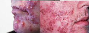 <p>ACNE NODULOCISTICA G3 </p><p>Pápulas + pústulas + comedões fechados e abertos + nódulos</p>