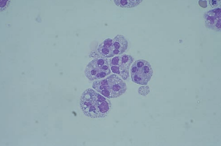 Figure 6: Neutrophils with cytoplasmic vacuoles