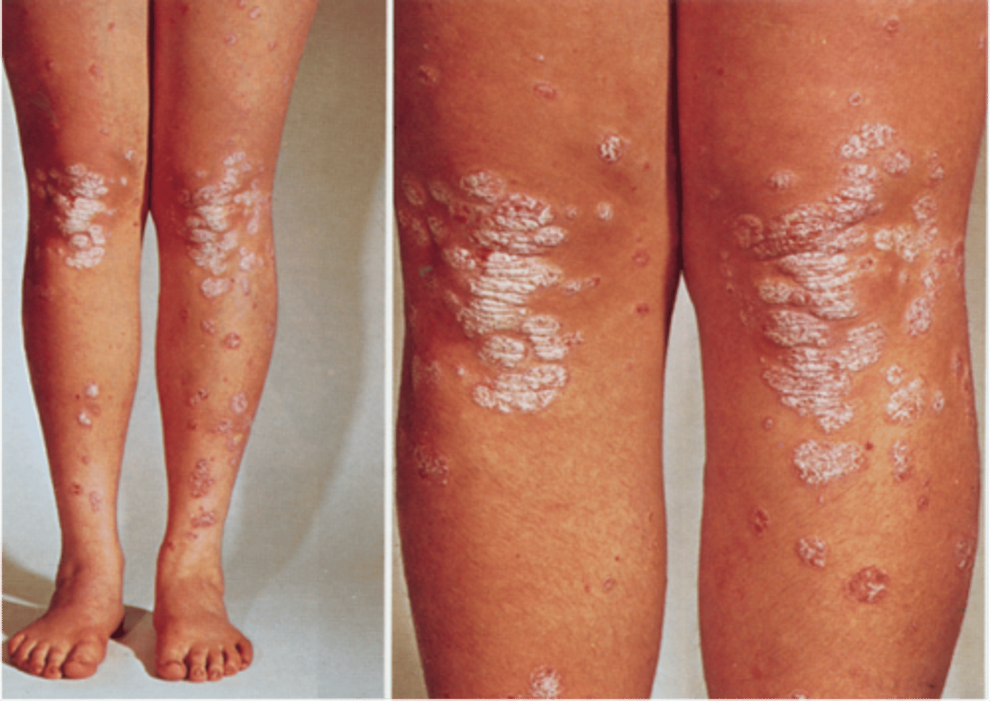 <p>name this skin pathology</p>