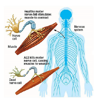 <p>increased neural activity </p><ul><li><p>found due to the fact if you give someone with ALS reducing neural activity drugs, it slows the progression</p></li></ul><p></p>
