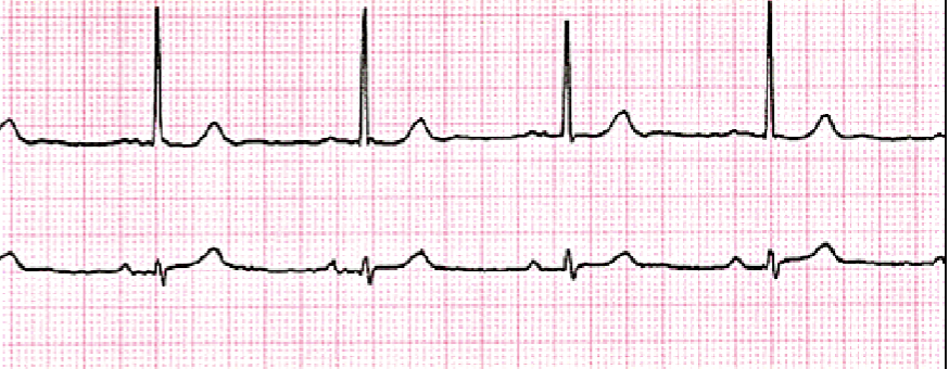 <p>Rate: Less than 60 BPM<br>Rhythm: Regular<br>P-Wave: Clear and Consistent<br>PR: 0.12-0.20<br>QRS: 0.06-0.10</p>