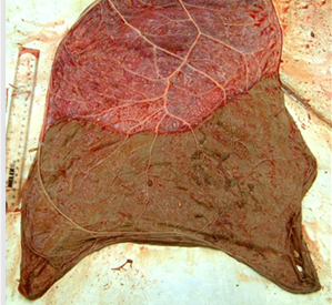 <p>What side of the placenta is this and describe the pathology</p>