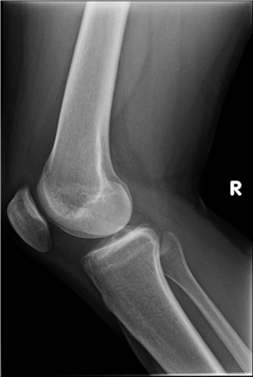 <p>- Not a true anatomical structure</p><p>- Appears due to less bone being traversed anteriorly than posteriorly</p>
