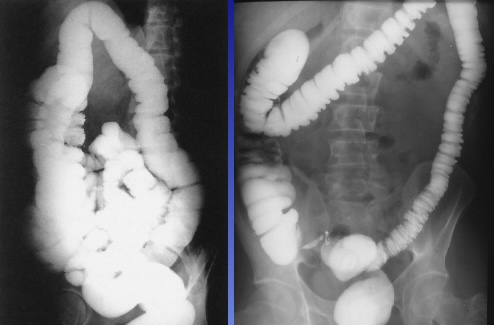 <p>What is this x-ray demonstrating?</p>