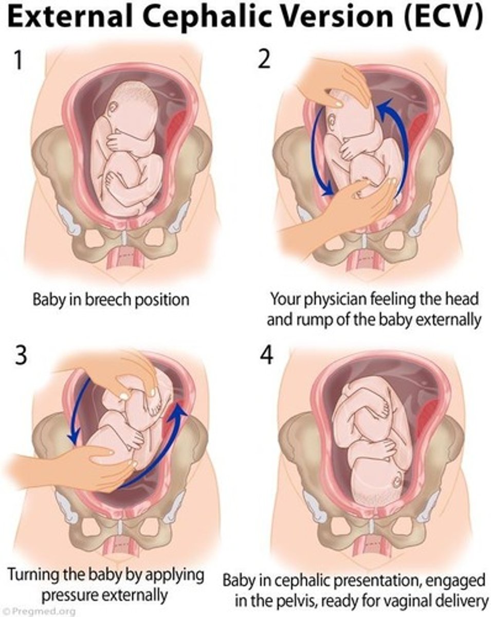 <p>A procedure to turn a fetus from a breech or shoulder presentation to a vertex presentation.</p>