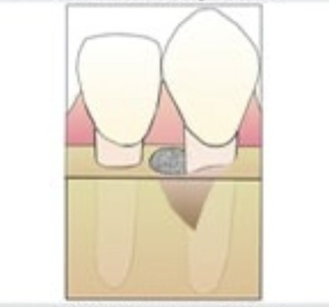 <p>This is a form of Infrabony pocket. When it is bordered by 3 osseous surfaces and 1 tooth surface. Has the best prognosis among the three bone defects.</p>