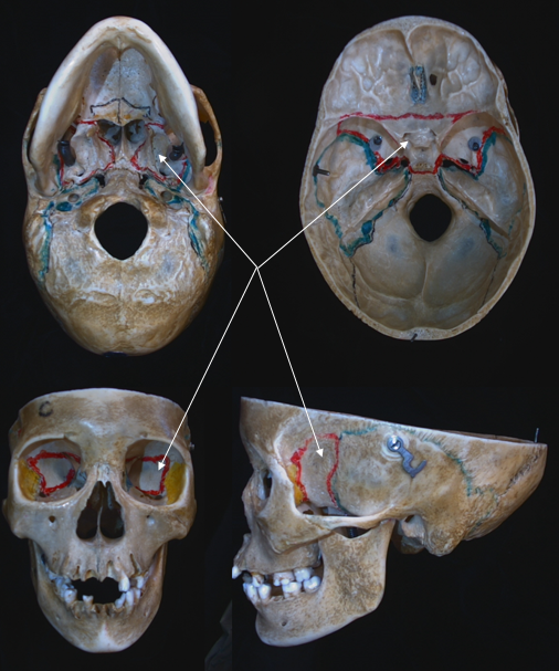 sphenoid bone 
