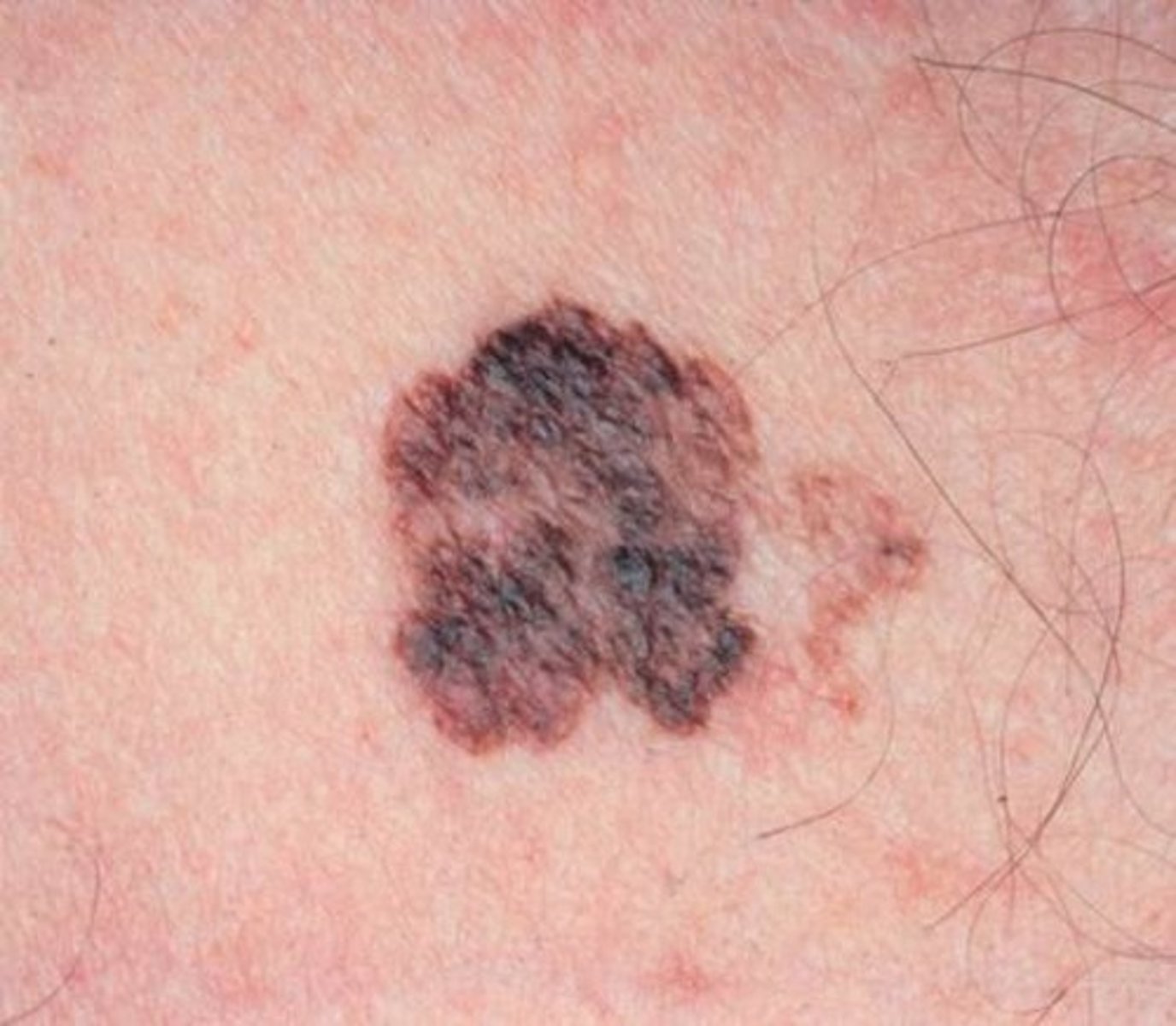 <p>-melanocytes</p><p>-dark spots not necessarily in sun-exposed areas</p><p>-ABCDE</p><p>-most deadly form of skin cancer (spreads quickly)</p>