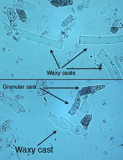<p>Waxy casts</p>