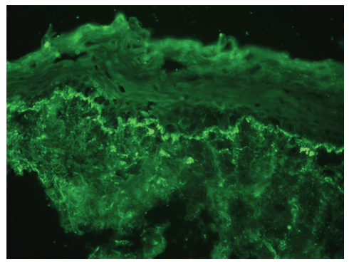 Fig. 41.18 Direct immunofluorescence of cutaneous lupus. Granular deposits
of IgM are present at the dermal–epidermal junction within lesional skin.
Antibody deposits at the dermal–epidermal junction are the most characteristic
immunohistologic finding in lesions of cutaneous lupus and normal skin of
patients with systemic lupus erythematosus