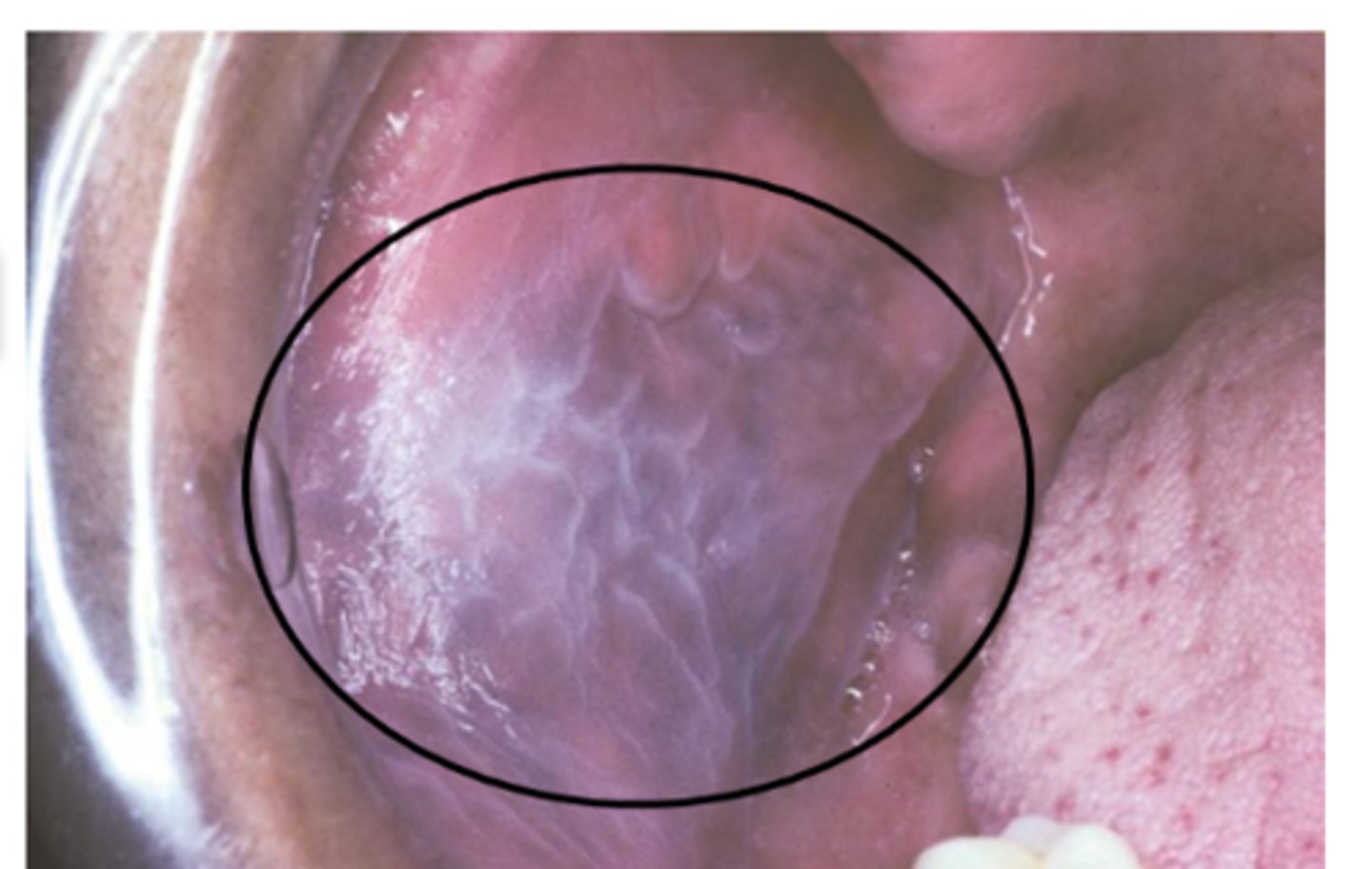 <p>You discovered a white, opalescent, opaque-appearing finding in your patient's buccal mucosa. What is the most likely diagnosis?</p>
