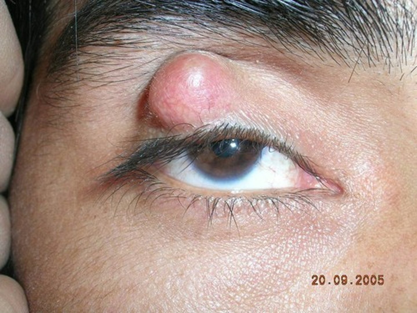 <p>A chalazion is noninfectious obstruction of a Meibomian gland causing extravasation of irritating lipid material in the eyelid soft tissues with focal secondary granulomatous inflammation</p>
