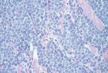 <ul><li><p>mast cells are disordered with different shapes </p></li><li><p>pleomorphic </p></li><li><p>tissue structures are being lost </p></li></ul><p></p>