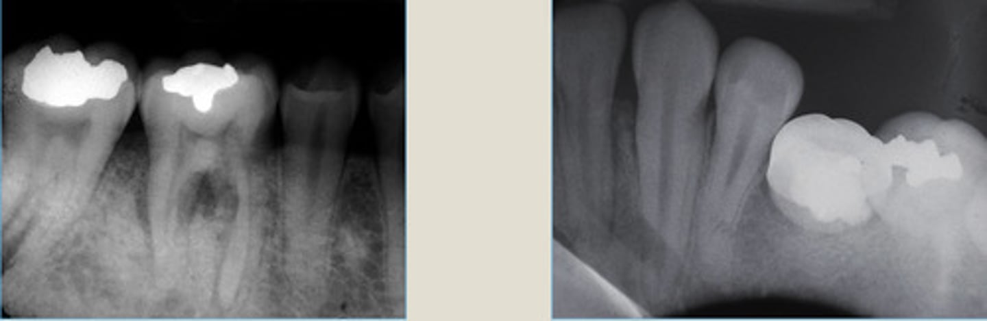 <p>widened PDL, increased density, no corticated edge</p>