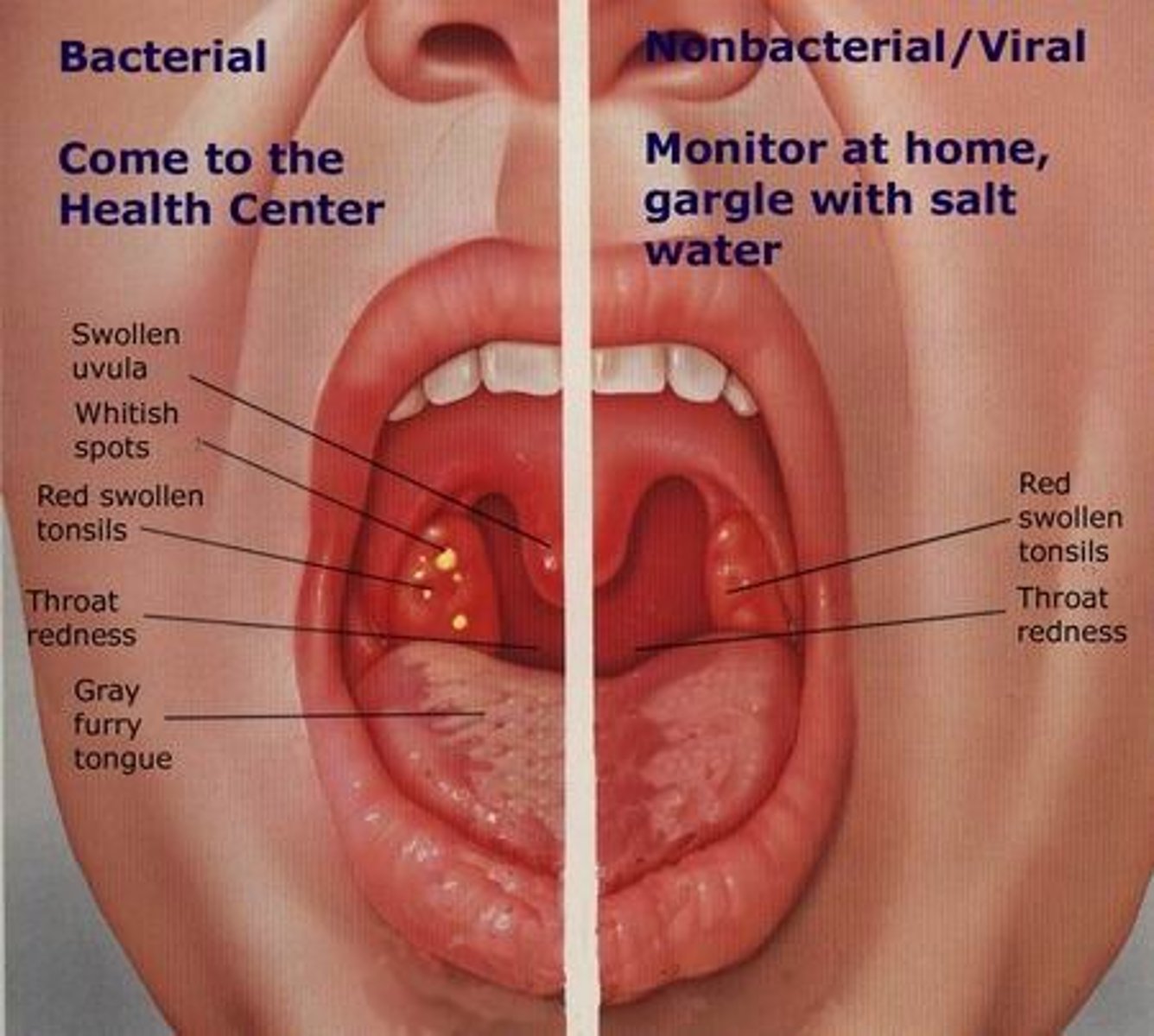 <p>Mild symptoms</p><p>treated with oral analgesics and gargling warm water</p>