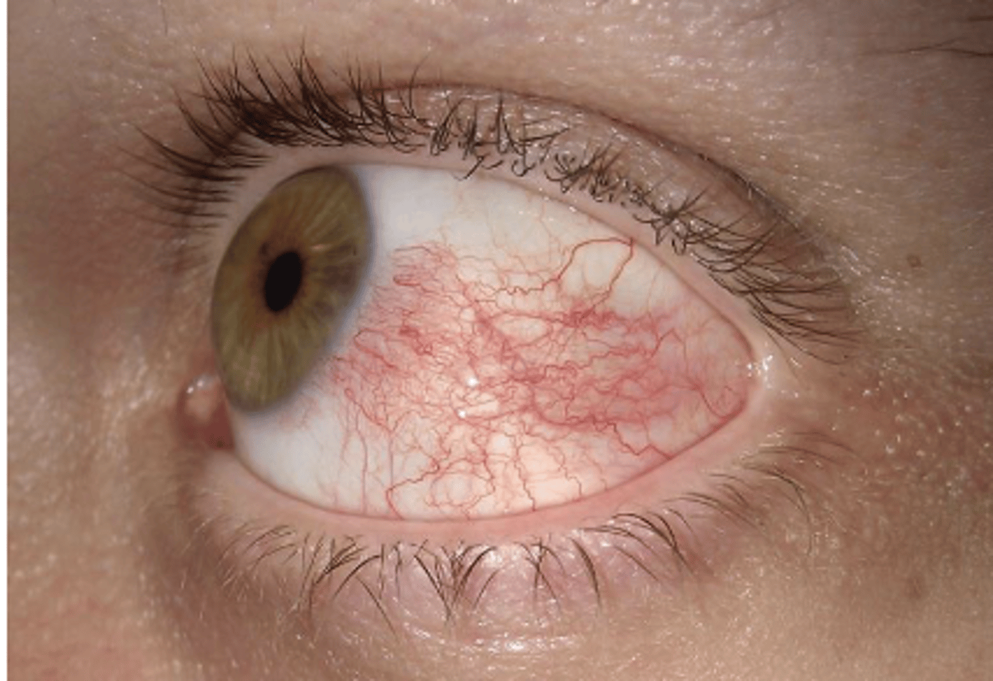 <p>What is the name of redness of the non-keratinized tissue that covers the sclera?</p>