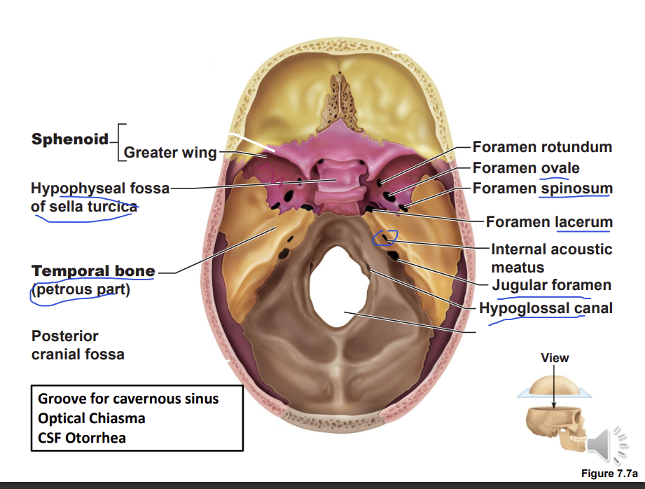 <p>sella turcica - pituitary gland is located</p><p>groove for the cavernous sinus is on the lateral aspect of the sell turcica</p><p>optical chiasma - the optic nerves cross each other leaving a groove</p><p>CFS otorrhea can happen if there is a fracture near the internal acoustic meatus </p>