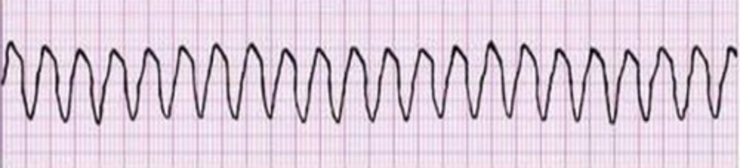 <p>rapid, wide waveform with no discernable p waves</p><p>- 100% O2, amiodarone, cardioversion (treatment to restore normal heartbeat) if unstable</p>