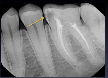 <p>classify this lesion based on the ADA caries classification system </p>
