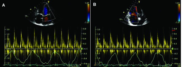 <p><span><span>The Doppler images are suggestive of what cardiac pathology or condition?</span></span></p><p>Constrictive Pericarditis</p><p>Pericardial effusion</p><p>Dressler's syndrome</p><p>Acute pericarditis</p><p>Restrictive Cardiomyopathy</p>