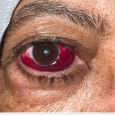<p>What might the patient be suffering from?</p><ul><li><p>The patient has hypertension and is taking blood thinners</p></li><li><p>The patient had a recent bout of vomiting sickness</p></li><li><p>The eyes are not painful and there is no change in vision</p></li><li><p>The redness is unilateral</p></li></ul><p></p>