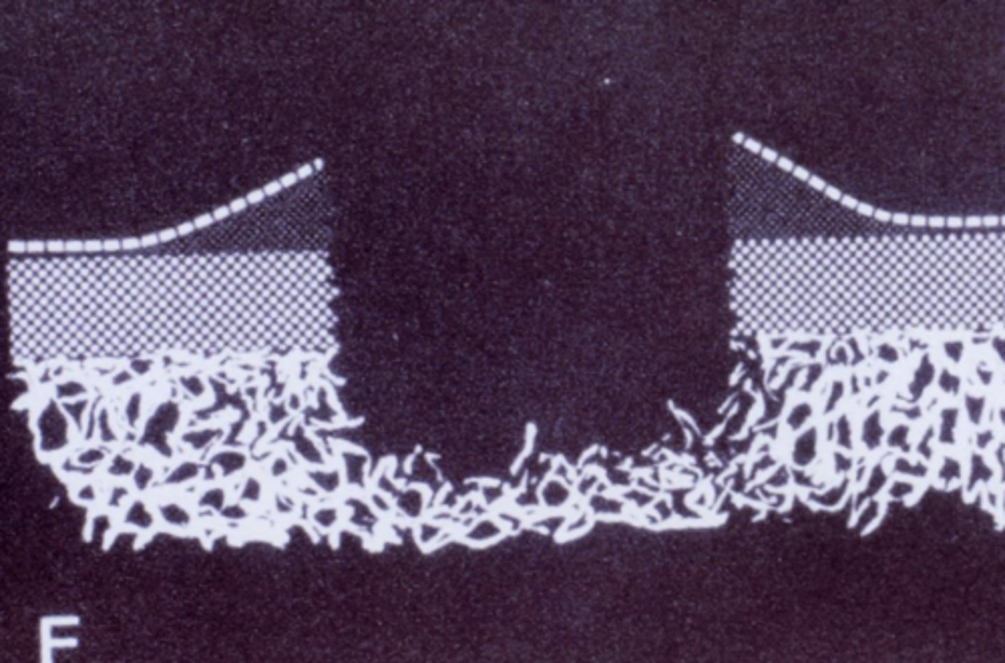 <p>as tumor grows, it pops up the periosteum - may show as dark triangle on radiograph</p><p>= lifting up of periosteum in response to a malignant tumor</p>