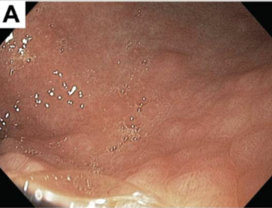 <p><strong><span>Describe the appearances of Lilly's stomach. &nbsp;How does this look different to Timmy's? </span></strong></p>