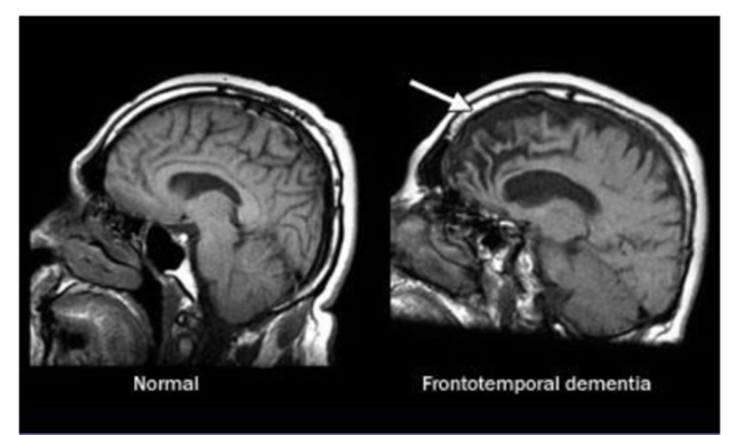 <p>Frontal and temporal damage, no amnesia in the early stages, clinical syndrome associated with shrinkage of the frontal and temporal lobes, impulsive or bored and listless, inappropriate social behaviors, neglect of personal hygiene, repetitive or compulsive behavior, speech problems, semantic deficits</p>