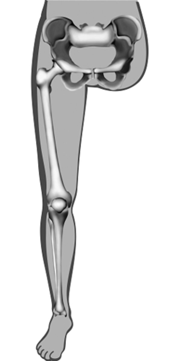 <p>Hip disarticulation</p>