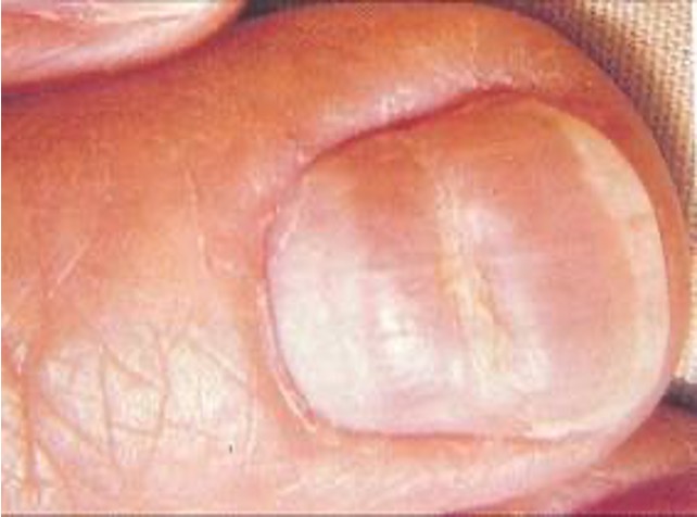 <p>traverse depression of nail plate, usually bilateral; sign that systemic illness or injury disrupted nail growth</p>