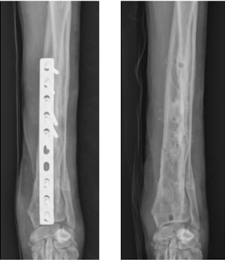 <p>If the fracture is not healed, it means rigid stabilization is required - bone will heal in the face of infection as long as it’s stable! </p>