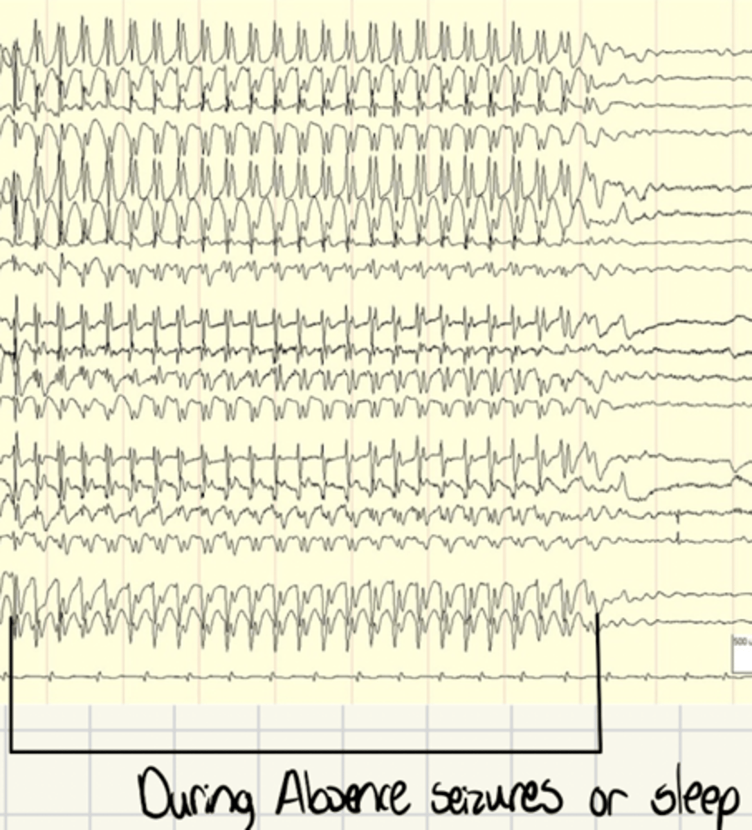 <p>During slow wave sleep there is a burst mode</p><p>Large waves in a rhythm</p><p>Results in oscillations that cancel out stimuli</p>