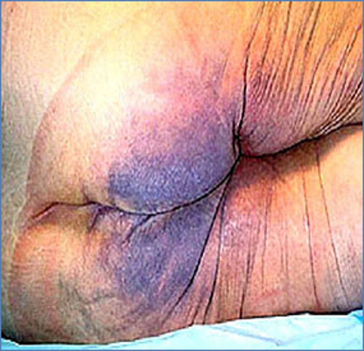 <p>Purple or maroon localized area of discolored intact skin</p>