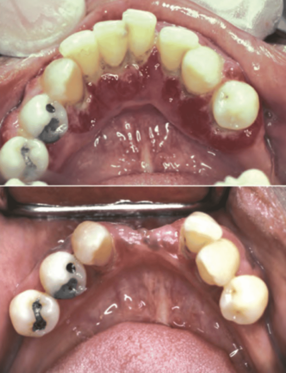 <p>-usually Type 1</p><p>-progressive periodontal disease</p><p>-enlarged erythematous gingiva</p><p>-delayed healing</p><p>-diabetic sialadenosis (diffuse bilateral enlargement of parotid glands)</p><p>-increased risk for candidiasis</p><p>-mucormycosis</p><p>-xerostomia</p>