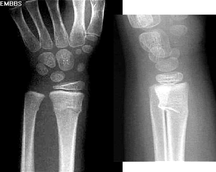 <p>compression fracture usually in children</p>