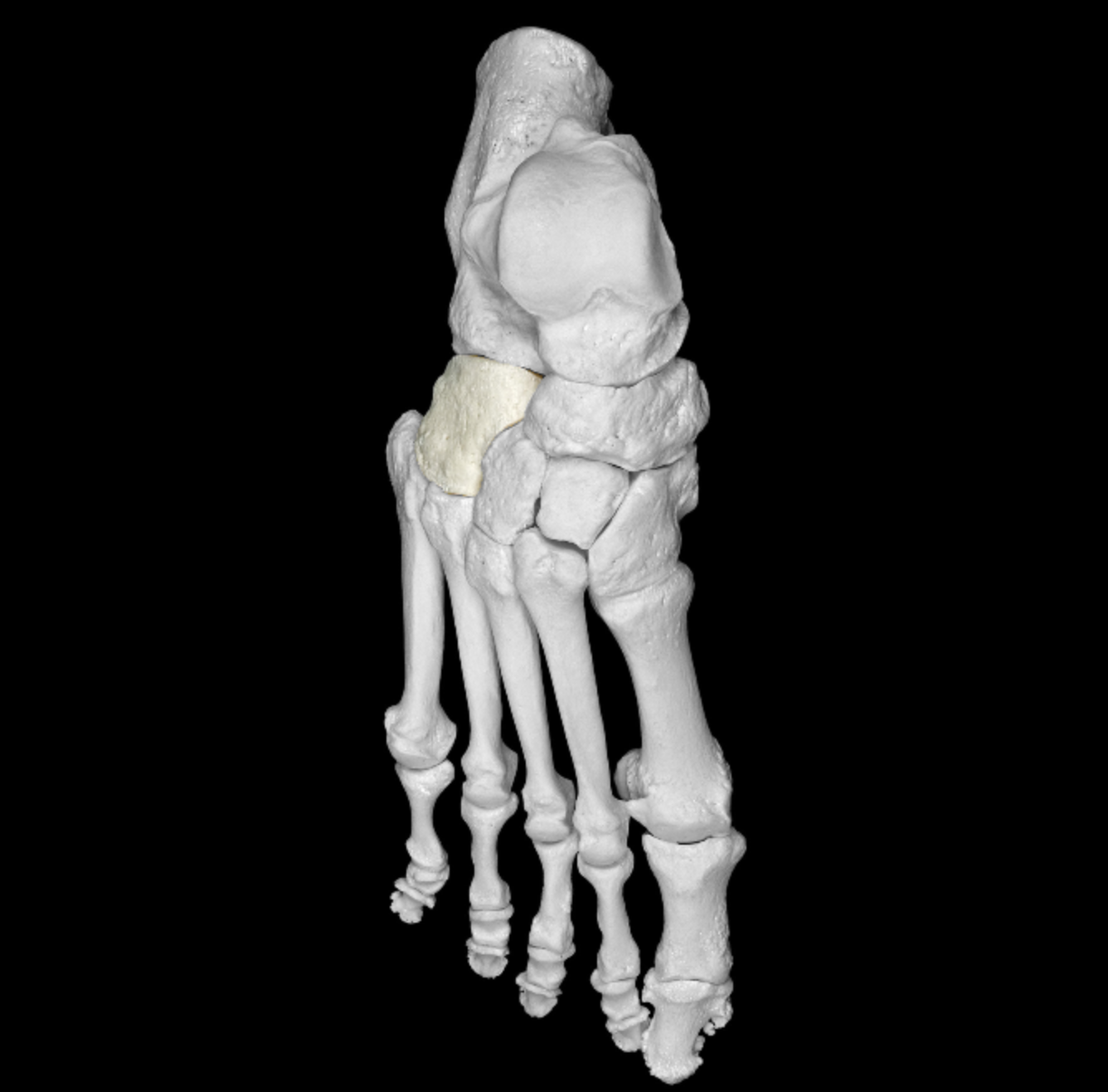 <p>lateral tarsal, posterior to metatarsal 4 + 5 </p>