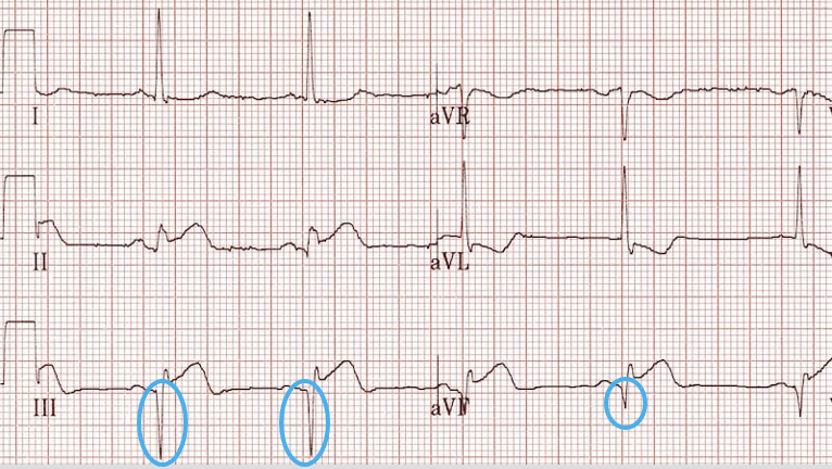 <p>longer than 0.4 sec or deeper than 2 small boxes or deeper than 25% of the R wave (if present)</p>