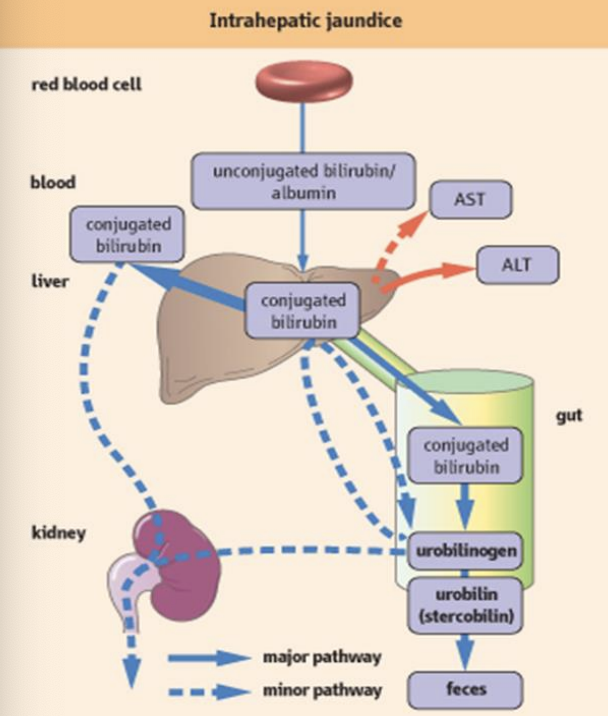 <p>A type of jaundice that occurs due to liver disease or damage, affecting the liver's ability to conjugate and excrete bilirubin, resulting in elevated conjugated bilirubin levels in the blood. </p>