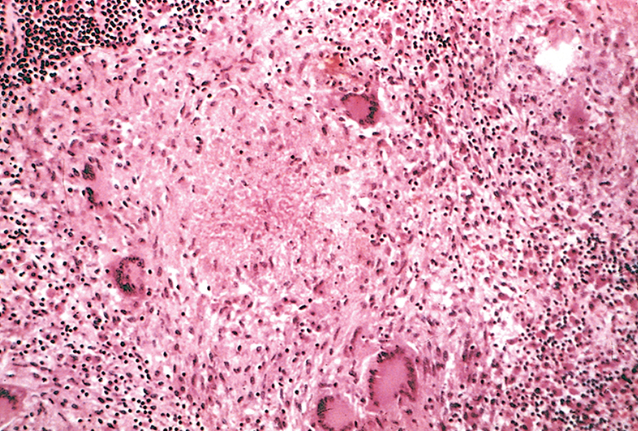 <p>caracterizada por cúmulos de macrófagos activados, a menudo con linfocitos T, y a veces asociada a necrosis</p>