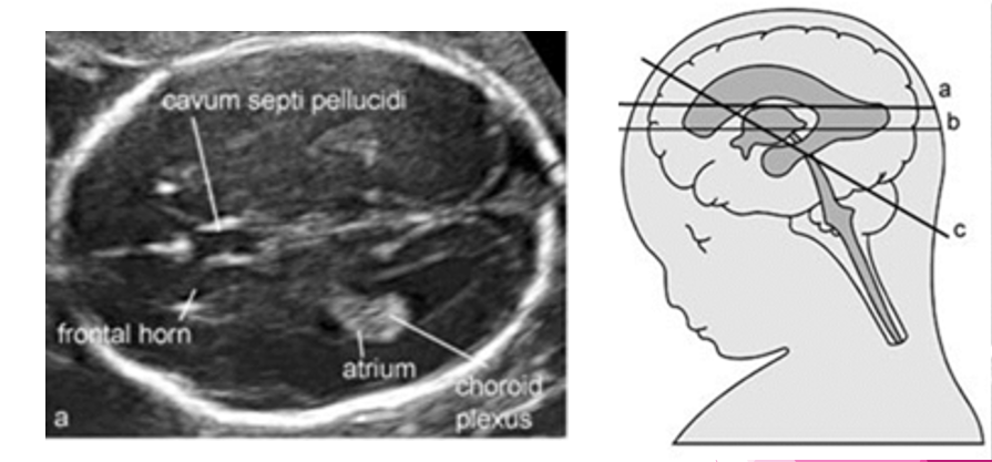 <p>landmarks: </p><ul><li><p>frontal horn</p></li><li><p>cavum septi pellucidi</p></li><li><p>atrium </p></li><li><p>choroid plexus</p></li></ul>