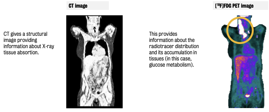 Example of SUV PET image for a [18F]FDG PET/CT whole body scan