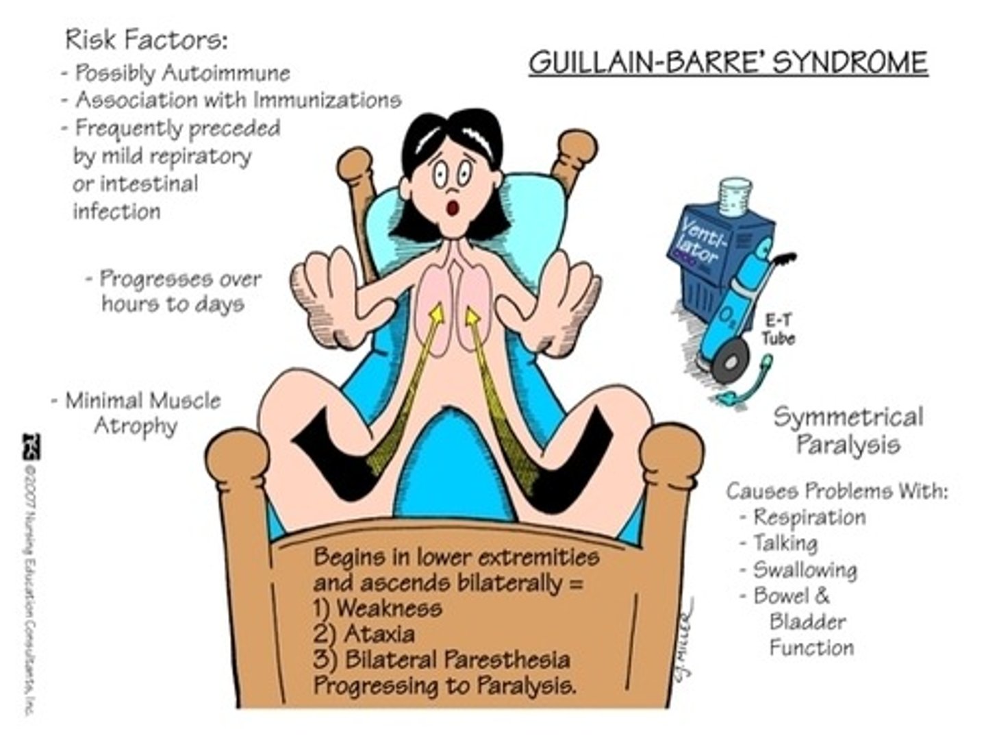 <p>B for bilaterally</p><p>AKA: Acute demyelinating polyradiculoneuropathy</p><p>What: autoimmune disease that attacks own peripheral nerves distal to proximal affecting bilaterally and ascends</p><p>LMN disorder</p><p>Who: Male>Female, any age group, usually someone that has had recent Respiratory or GI infection/virus</p><p>Clinical presentation</p><p>-Stocking glove distribution of ascending and bilateral weakness that rapidly occurs for 2-3 weeks but progressing no greater than 4 weeks (nadir)</p><p>- can progress to lung function and put pt on vents</p><p>-Diminished DTRs</p>