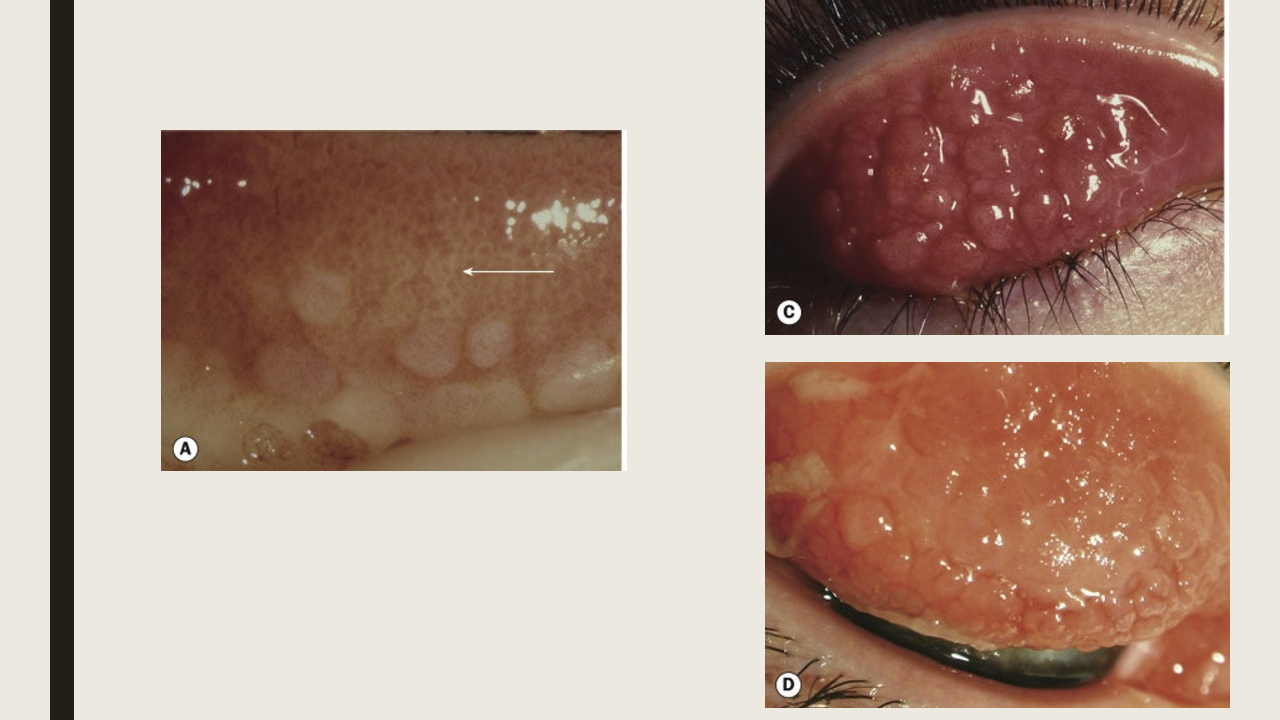 <ul><li><p>Macropapillae of superior tarsal plate, less than 1mm</p></li><li><p>Giant papillae of superior tarsal plate, larger than 1mm with mucus seen between giant papillae&nbsp;</p></li><li><p>Conj hyperemia&nbsp;</p></li></ul><p></p>