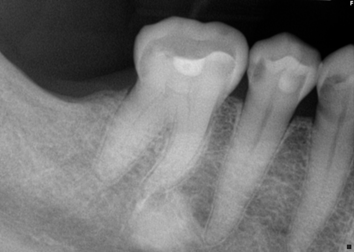 <p>What is this lesion? </p>