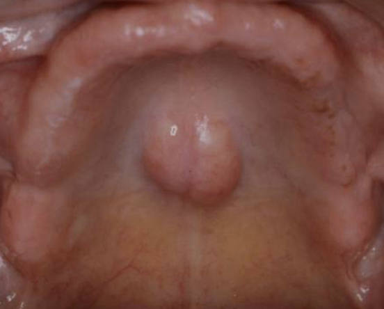 <p>outline torus palatini and its affect on wearing dentures </p>